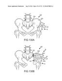 INTEGRATED ELECTROMAGNETIC IMPLANT GUIDANCE SYSTEMS AND METHODS OF USE FOR     SACROILIAC JOINT FUSION diagram and image