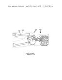 INTEGRATED ELECTROMAGNETIC IMPLANT GUIDANCE SYSTEMS AND METHODS OF USE FOR     SACROILIAC JOINT FUSION diagram and image