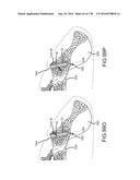 INTEGRATED ELECTROMAGNETIC IMPLANT GUIDANCE SYSTEMS AND METHODS OF USE FOR     SACROILIAC JOINT FUSION diagram and image