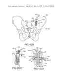 INTEGRATED ELECTROMAGNETIC IMPLANT GUIDANCE SYSTEMS AND METHODS OF USE FOR     SACROILIAC JOINT FUSION diagram and image
