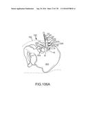 INTEGRATED ELECTROMAGNETIC IMPLANT GUIDANCE SYSTEMS AND METHODS OF USE FOR     SACROILIAC JOINT FUSION diagram and image