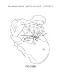 INTEGRATED ELECTROMAGNETIC IMPLANT GUIDANCE SYSTEMS AND METHODS OF USE FOR     SACROILIAC JOINT FUSION diagram and image