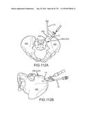 INTEGRATED ELECTROMAGNETIC IMPLANT GUIDANCE SYSTEMS AND METHODS OF USE FOR     SACROILIAC JOINT FUSION diagram and image