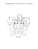 INTEGRATED ELECTROMAGNETIC IMPLANT GUIDANCE SYSTEMS AND METHODS OF USE FOR     SACROILIAC JOINT FUSION diagram and image