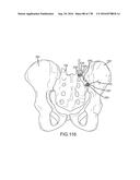 INTEGRATED ELECTROMAGNETIC IMPLANT GUIDANCE SYSTEMS AND METHODS OF USE FOR     SACROILIAC JOINT FUSION diagram and image