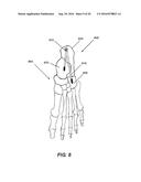 INTRAOSSEOUS INTRAMEDULLARY FIXATION ASSEMBLY AND METHOD OF USE diagram and image