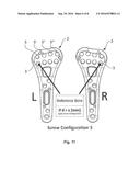 METHOD FOR TREATING FRACTURES OF A BONE diagram and image