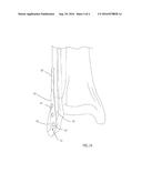 OSTEOSYNTHESIS PLATE FOR DISTAL FIBULA / LATERAL MALLEOULUS diagram and image