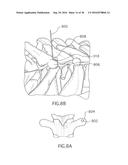 Method for Treating the Thoracic Region of a Patient s Body diagram and image