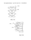 Method for Treating the Thoracic Region of a Patient s Body diagram and image