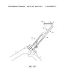 DISPOSABLE MULTI-PURPOSE TOOL FOR TOTAL KNEE ARTHROPLASTY diagram and image