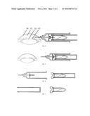 A Disposable Negative-pressure Anterior Chamber Paracentesis syringe diagram and image