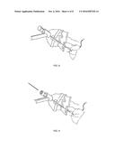 BIOPSY NEEDLE diagram and image