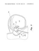 APPARATUS FOR CLOSURE OF ATRIAL SEPTAL DEFECTS diagram and image