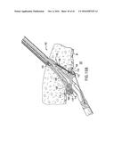 ARTICULATING SUTURING DEVICE AND METHOD diagram and image