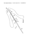 ARTICULATING SUTURING DEVICE AND METHOD diagram and image