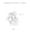 PATENT FORAMEN OVALE CLOSURE SYSTEM diagram and image