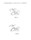 PATENT FORAMEN OVALE CLOSURE SYSTEM diagram and image