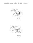 PATENT FORAMEN OVALE CLOSURE SYSTEM diagram and image