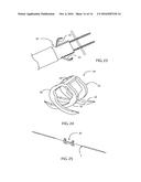 PATENT FORAMEN OVALE CLOSURE SYSTEM diagram and image