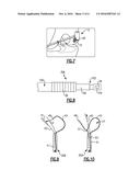 METHOD OF REPAIRING CARTILAGE DEFECTS diagram and image