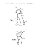 METHOD OF REPAIRING CARTILAGE DEFECTS diagram and image