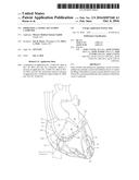 Operating A Vessel Occlusion Catheter diagram and image