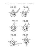 Percutaneous Disc Clearing Device diagram and image