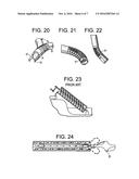 Percutaneous Disc Clearing Device diagram and image