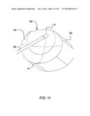 GLENOID REPAIR SYSTEM AND METHODS OF USE THEREOF diagram and image