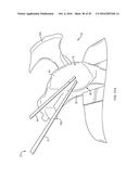 GLENOID REPAIR SYSTEM AND METHODS OF USE THEREOF diagram and image