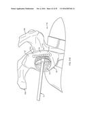 GLENOID REPAIR SYSTEM AND METHODS OF USE THEREOF diagram and image