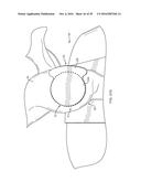 GLENOID REPAIR SYSTEM AND METHODS OF USE THEREOF diagram and image