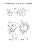 Valvuloplasty Catheter diagram and image