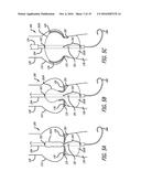 Valvuloplasty Catheter diagram and image