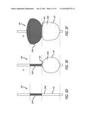 Valvuloplasty Catheter diagram and image