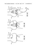 Valvuloplasty Catheter diagram and image