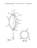 Valvuloplasty Catheter diagram and image