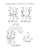 Valvuloplasty Catheter diagram and image