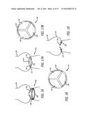 Valvuloplasty Catheter diagram and image