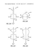 Valvuloplasty Catheter diagram and image