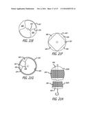 Valvuloplasty Catheter diagram and image