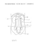 METHOD FOR REMOVING CALCULUS FROM AN ACCESS SHEATH diagram and image