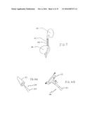 METHOD FOR REMOVING CALCULUS FROM AN ACCESS SHEATH diagram and image