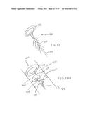 METHOD FOR REMOVING CALCULUS FROM AN ACCESS SHEATH diagram and image