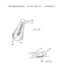 METHODS FOR REMOVING CALCULUS FROM AN ACCESS SHEATH diagram and image