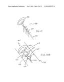 METHODS FOR REMOVING CALCULUS FROM AN ACCESS SHEATH diagram and image