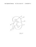 METHOD FOR REMOVING CALCULUS FROM AN ACCESS SHEATH diagram and image