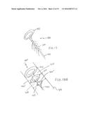 METHOD FOR REMOVING CALCULUS FROM AN ACCESS SHEATH diagram and image