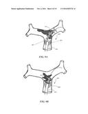 METHODS AND APPARATUS FOR TREATING EMBOLISM diagram and image